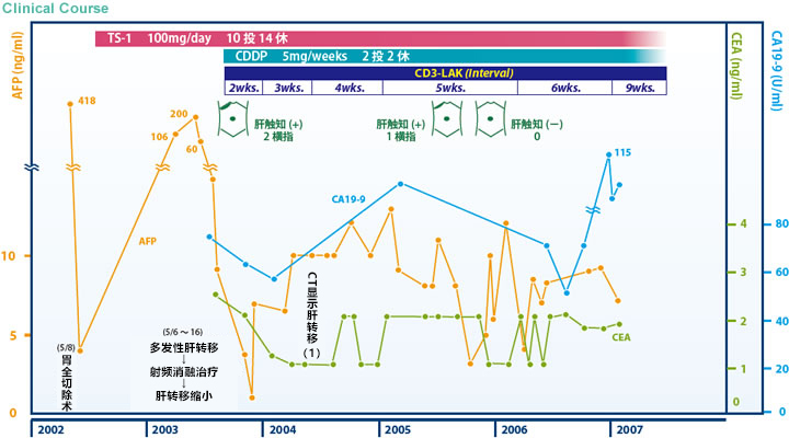 日本免疫細胞治療(瀨田診所)：胃癌，女，62歲