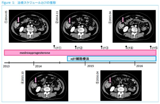 子宮內膜癌使用免疫細胞治療效果如何？